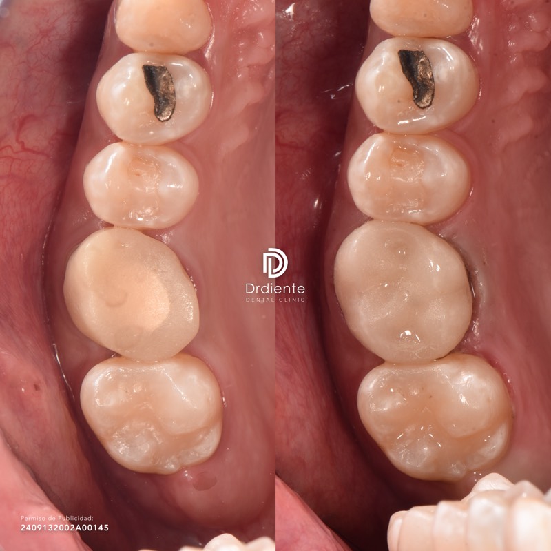 Before and after — Full-Arch Restoration — Finished Case at DrDiente Mexico City
