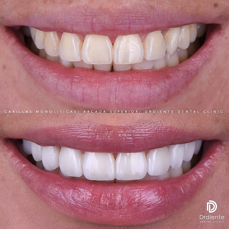 Before and after dental veneers case 1 at DrDiente Polanco, Mexico City