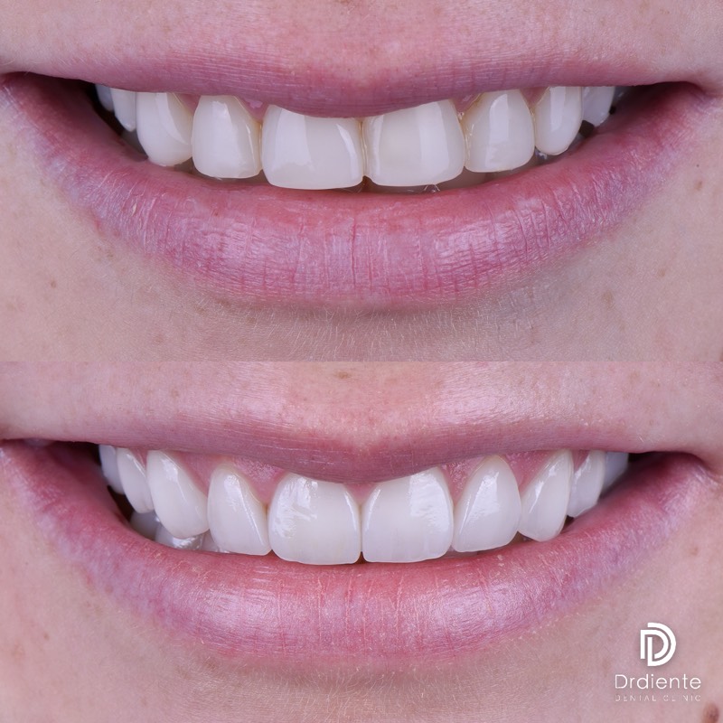 Before and after — Smile Design + Whitening at DrDiente Mexico City