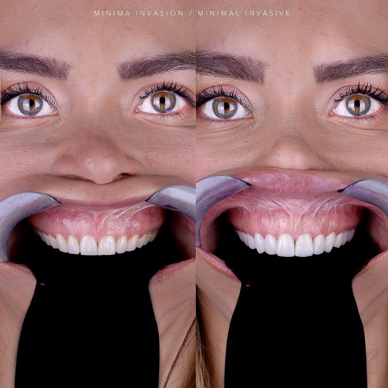 Before and after — Veneers + Gum Contouring at DrDiente Mexico City