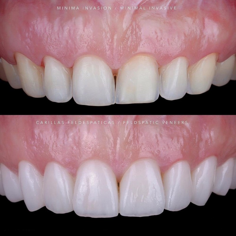 Before and after — Veneers + Gum Contouring at DrDiente Mexico City