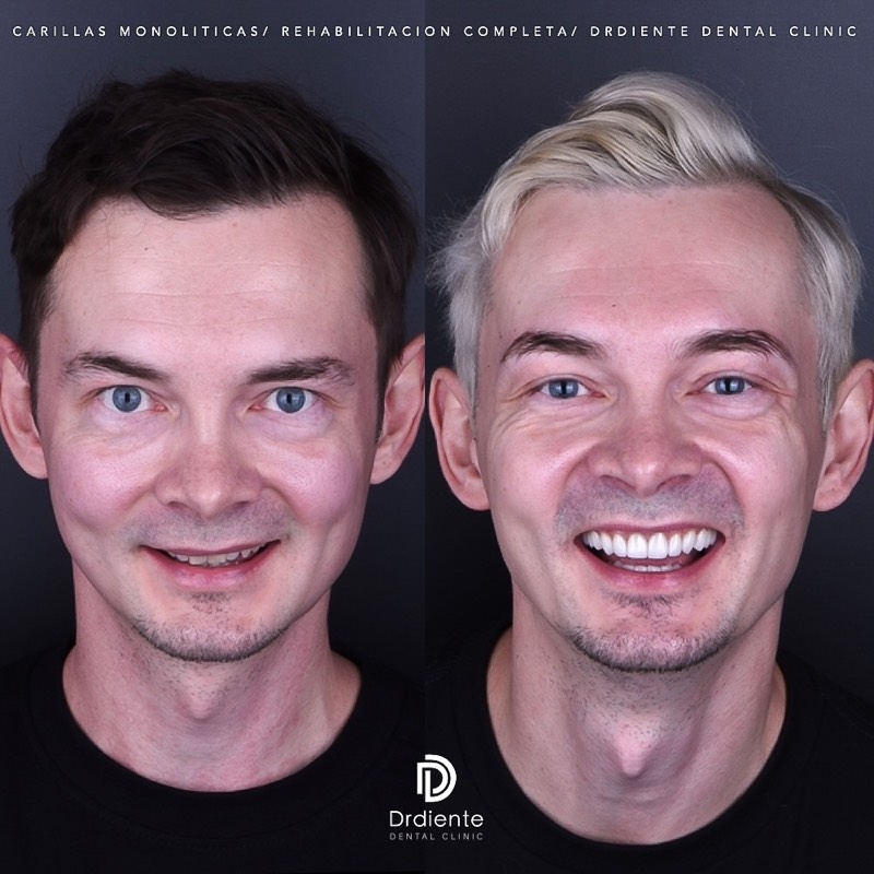 Before and after — Hollywood Smile — Full Arch at DrDiente Mexico City