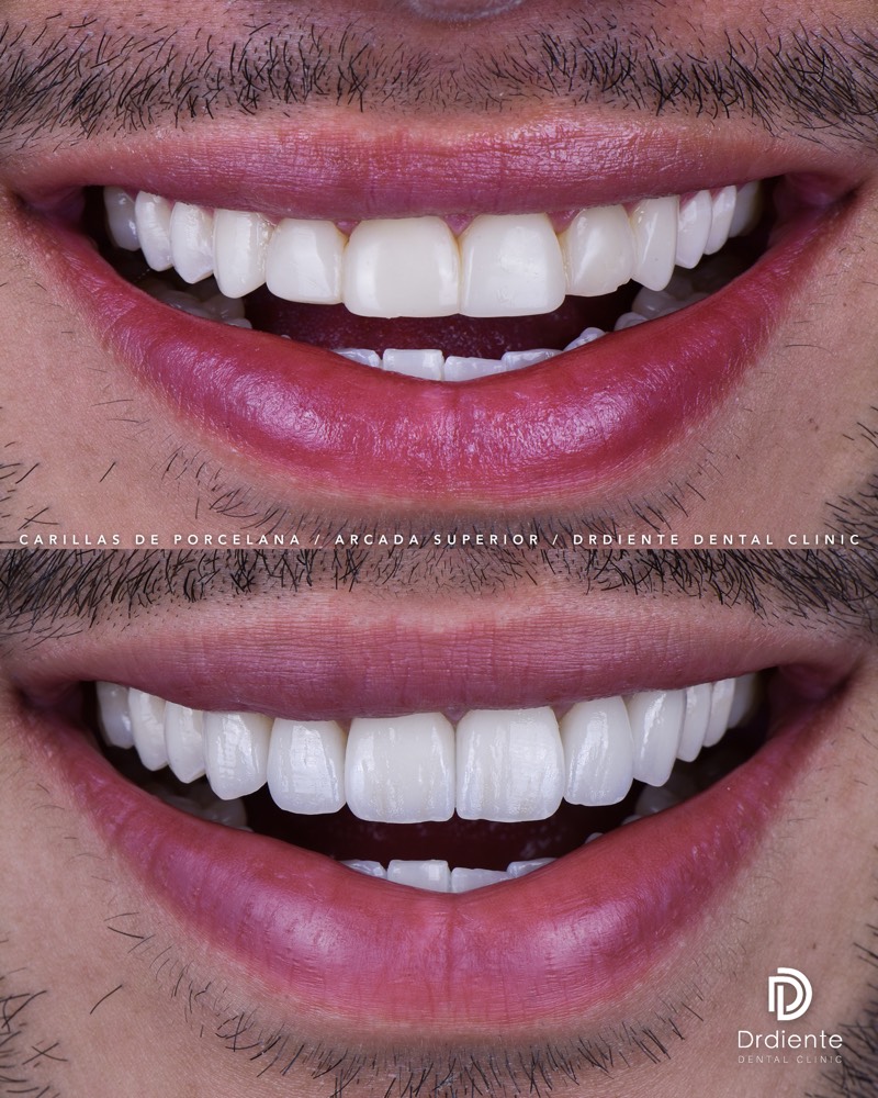 Before and after — Digital Smile Design — Veneers at DrDiente Mexico City