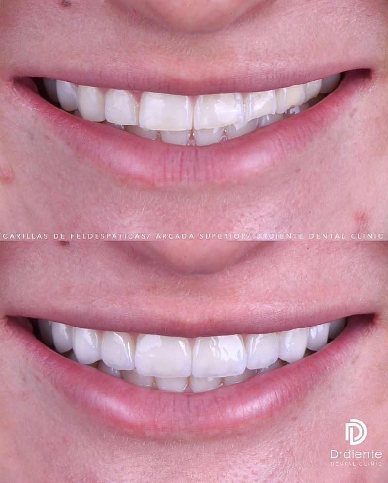 Before and after — Porcelain Veneers — Finished Case at DrDiente Mexico City