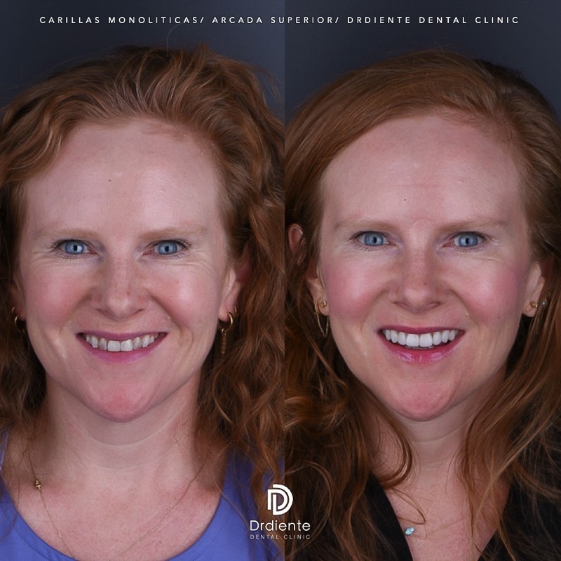 Before and after — Full Makeover — Crowns & Veneers at DrDiente Mexico City