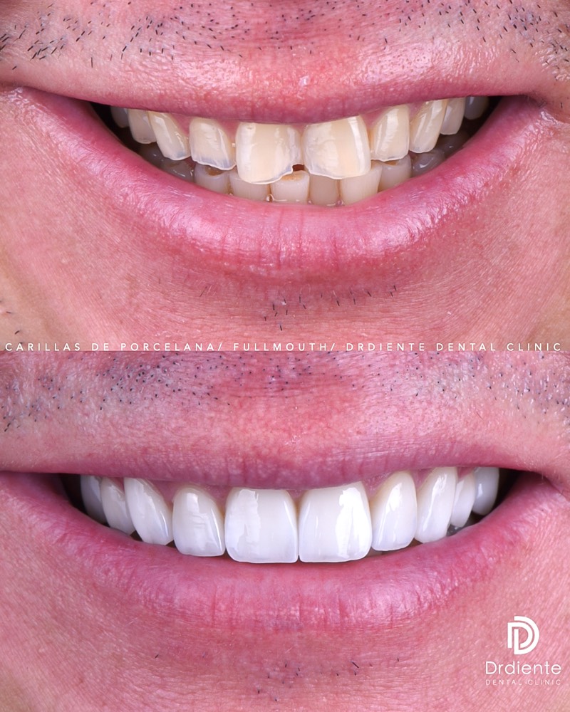 Before and after dental veneers case 4 at DrDiente Polanco, Mexico City