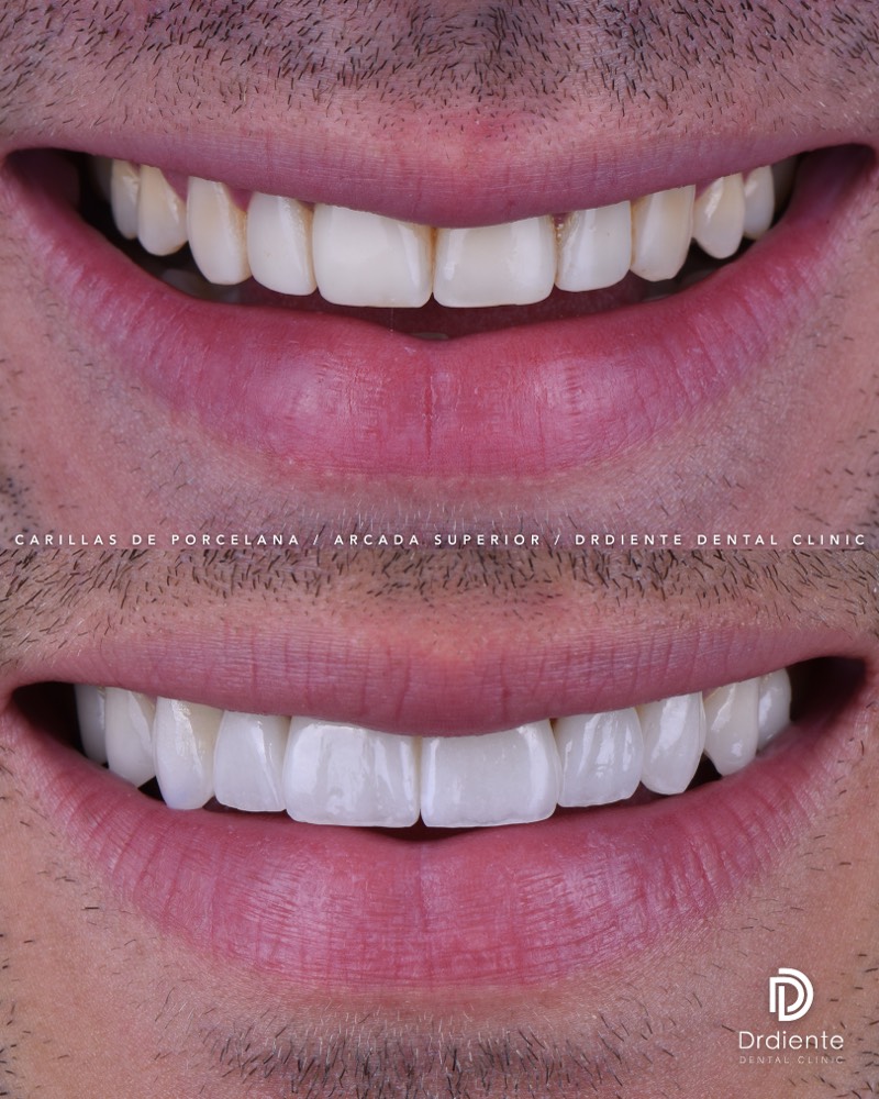 Before and after dental veneers case 7 at DrDiente Polanco, Mexico City