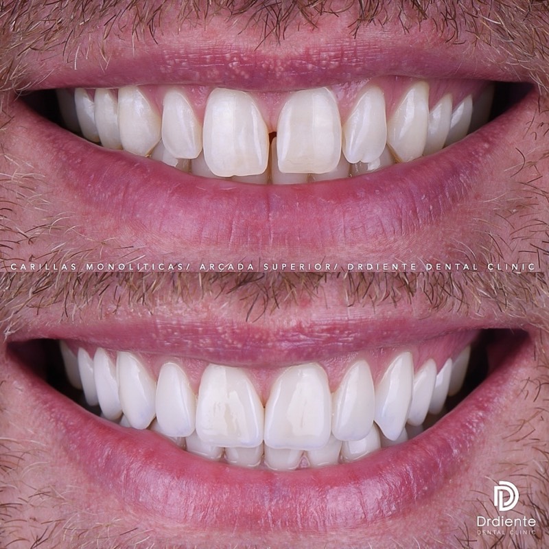 Before and after — E-max Veneers — Natural Translucency at DrDiente Mexico City