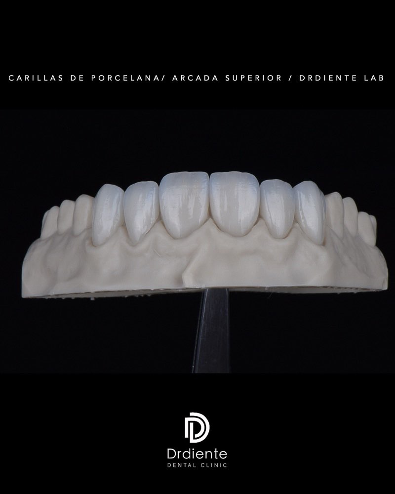 Digital Smile Design in Mexico City — Smile Makeover at DrDiente Polanco