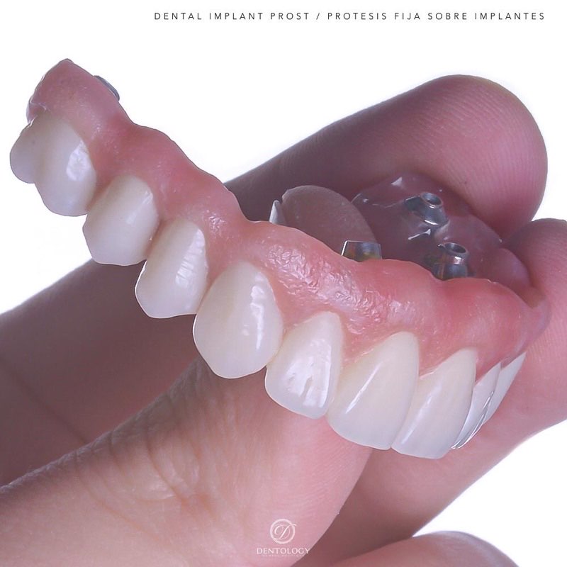 All-on-4 dental implants Mexico City — DrDiente Polanco
